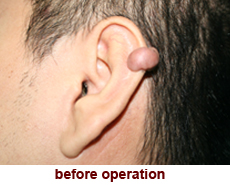 plastic-surgery-keloid-excision